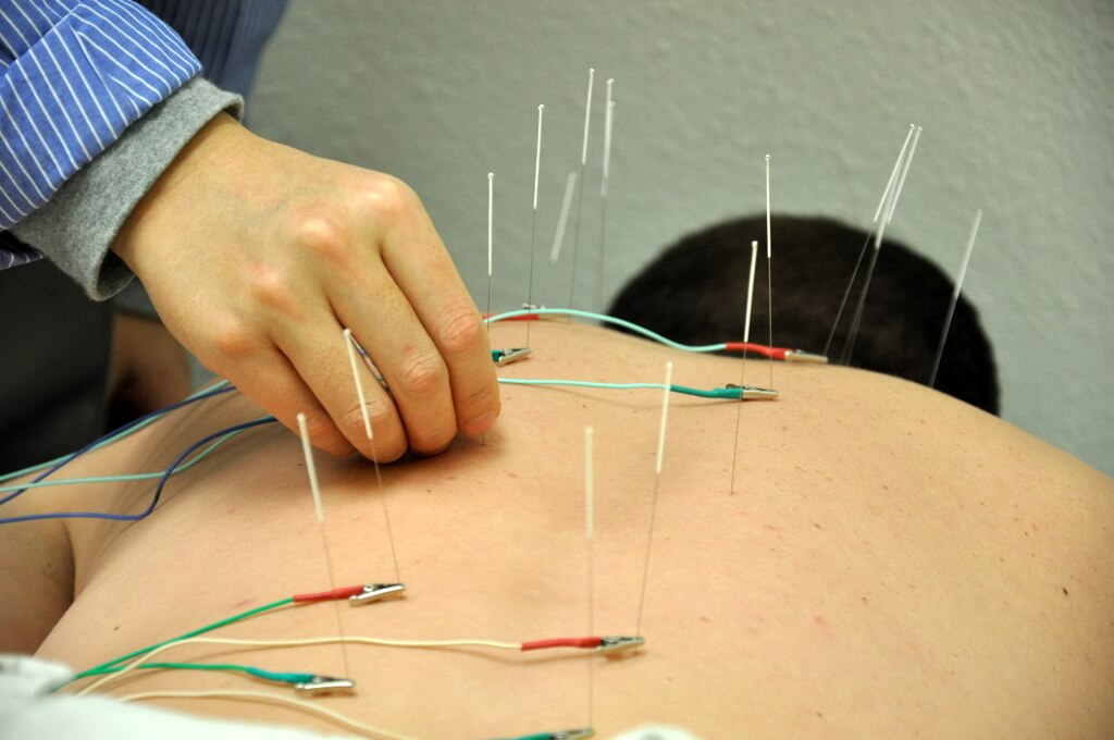 The Electric Acupuncture Nightmare